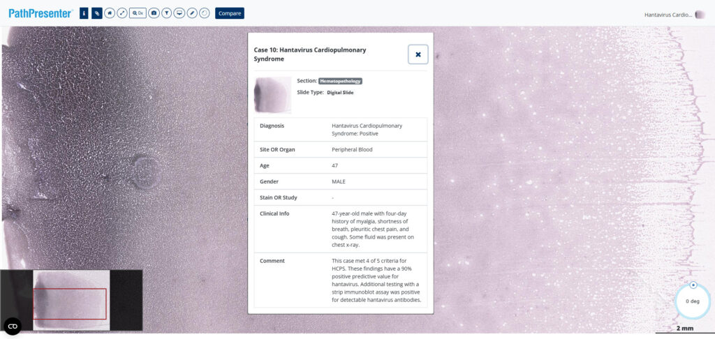 Whole slide digital pathology blood smear image for hantavirus screening